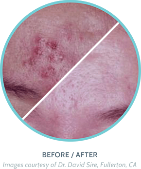 Acne Treatment Before / After Image 1