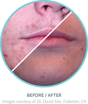 Acne Treatment Before / After Image 2