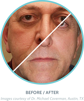 Skin Rejuvenation Treatment Before / After Image 1
