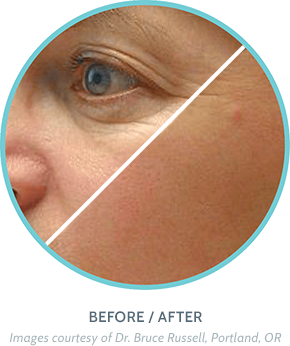 Skin Rejuvenation Treatment Before / After Image 2