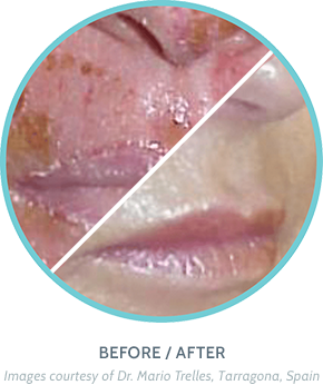 Wound Healing Treatment Before / After Image 1